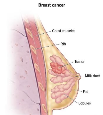 breast_cancer