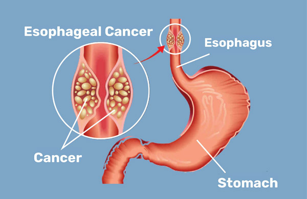 esophagus