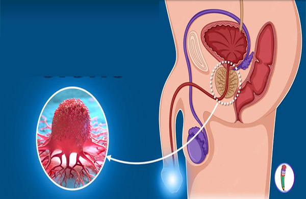 prostate